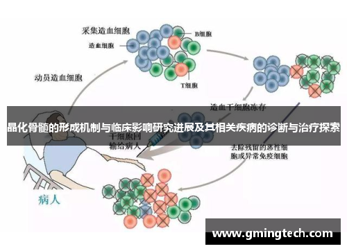 晶化骨髓的形成机制与临床影响研究进展及其相关疾病的诊断与治疗探索